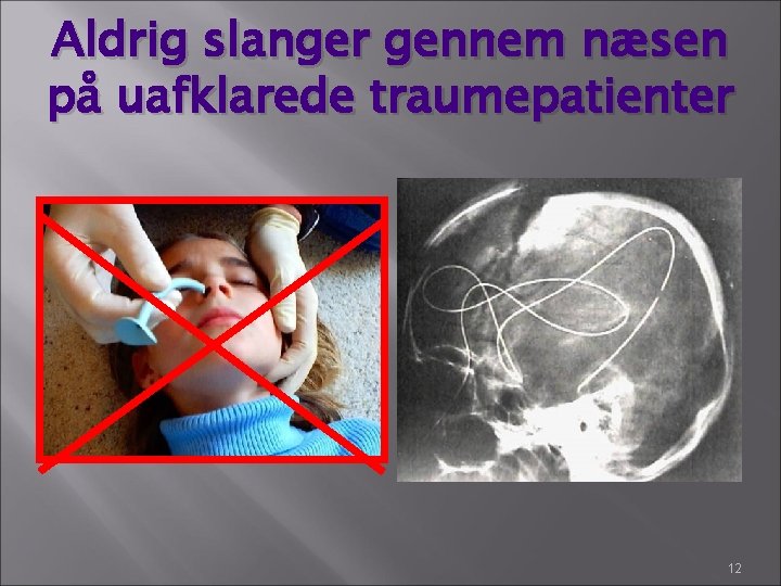 Aldrig slanger gennem næsen på uafklarede traumepatienter 12 Aldrig slanger gennem næsen på uafklarede traumepatienter 12