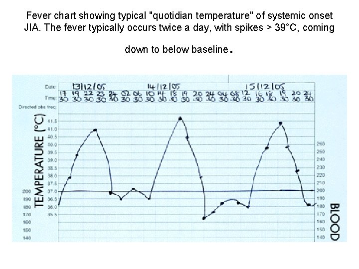 Fever chart showing typical "quotidian temperature" of systemic onset JIA. The fever typically occurs