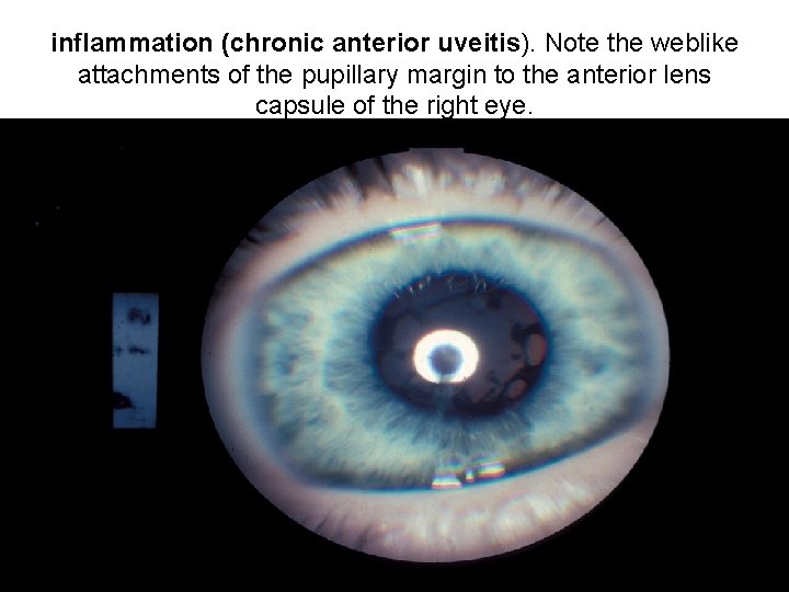 inflammation (chronic anterior uveitis). Note the weblike attachments of the pupillary margin to the