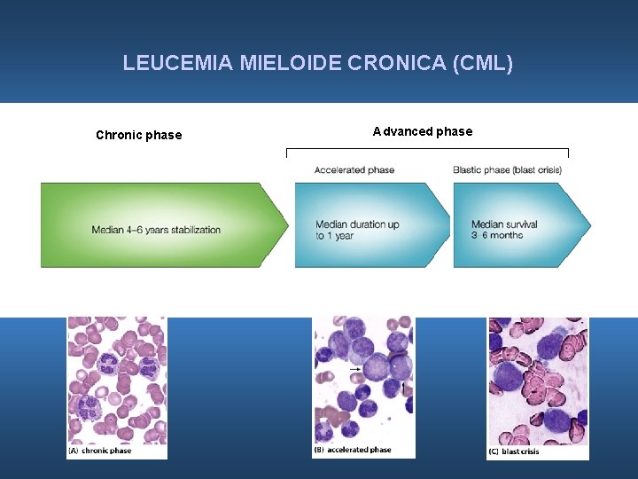 LEUCEMIA MIELOIDE CRONICA (CML) Chronic phase Advanced phase 