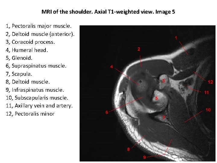 MRI of the shoulder. Axial T 1 -weighted view. Image 5 1, Pectoralis major