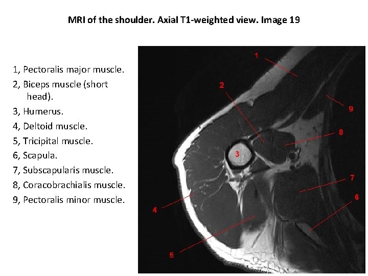 MRI of the shoulder. Axial T 1 -weighted view. Image 19 1, Pectoralis major