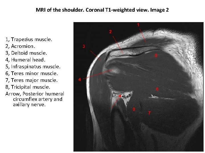 MRI of the shoulder. Coronal T 1 -weighted view. Image 2 1, Trapezius muscle.