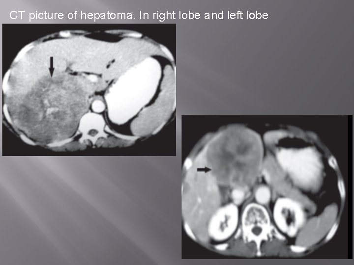 CT picture of hepatoma. In right lobe and left lobe 