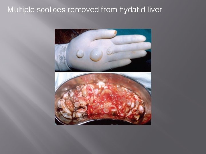 Multiple scolices removed from hydatid liver 