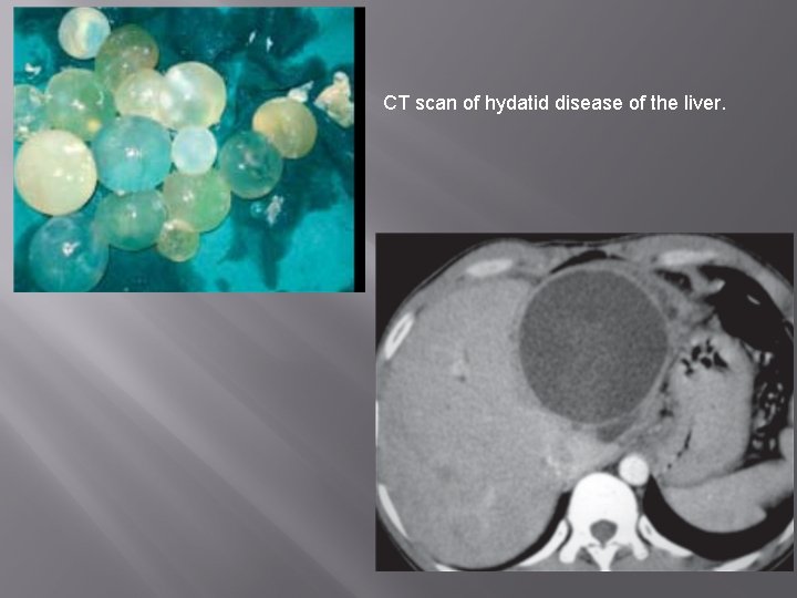 CT scan of hydatid disease of the liver. 