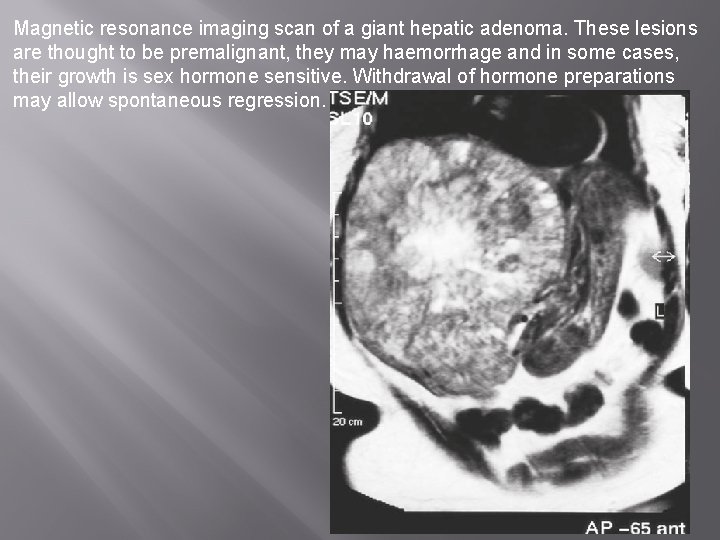 Magnetic resonance imaging scan of a giant hepatic adenoma. These lesions are thought to