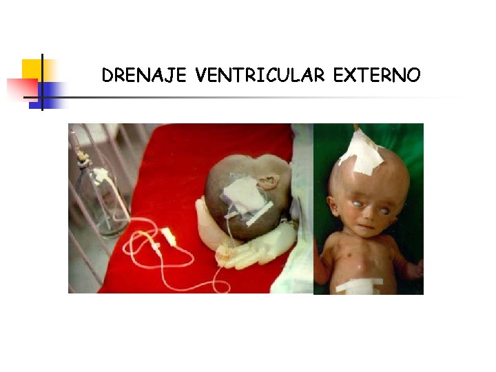 DRENAJE VENTRICULAR EXTERNO 