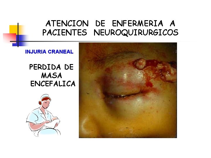 ATENCION DE ENFERMERIA A PACIENTES NEUROQUIRURGICOS INJURIA CRANEAL PERDIDA DE MASA ENCEFALICA 