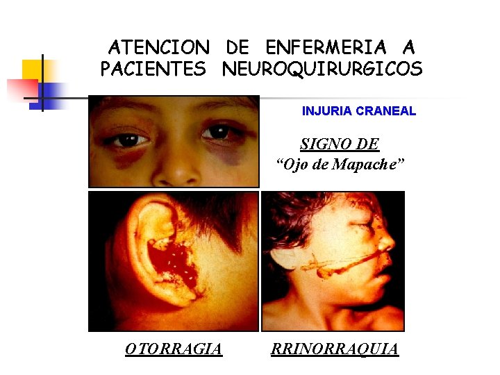 ATENCION DE ENFERMERIA A PACIENTES NEUROQUIRURGICOS INJURIA CRANEAL SIGNO DE “Ojo de Mapache” OTORRAGIA