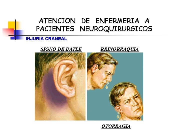 ATENCION DE ENFERMERIA A PACIENTES NEUROQUIRURGICOS INJURIA CRANEAL SIGNO DE BATLE RRINORRAQUIA OTORRAGIA 