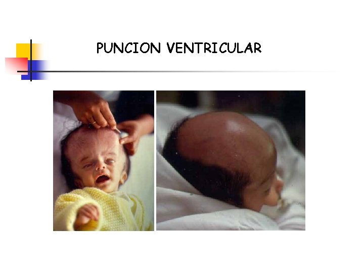 PUNCION VENTRICULAR 