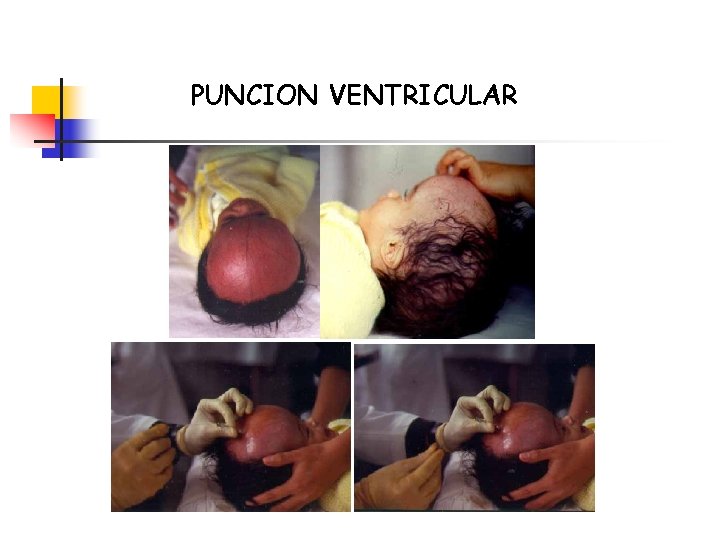 PUNCION VENTRICULAR 