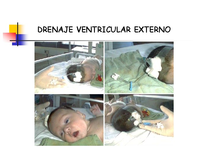 DRENAJE VENTRICULAR EXTERNO 