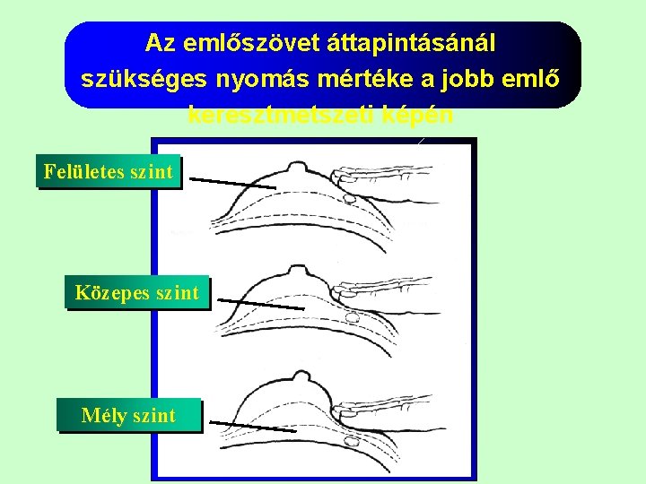 Az emlőszövet áttapintásánál szükséges nyomás mértéke a jobb emlő keresztmetszeti képén Felületes szint Közepes