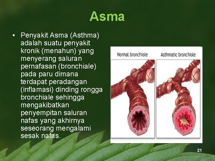 Asma • Penyakit Asma (Asthma) adalah suatu penyakit kronik (menahun) yang menyerang saluran pernafasan