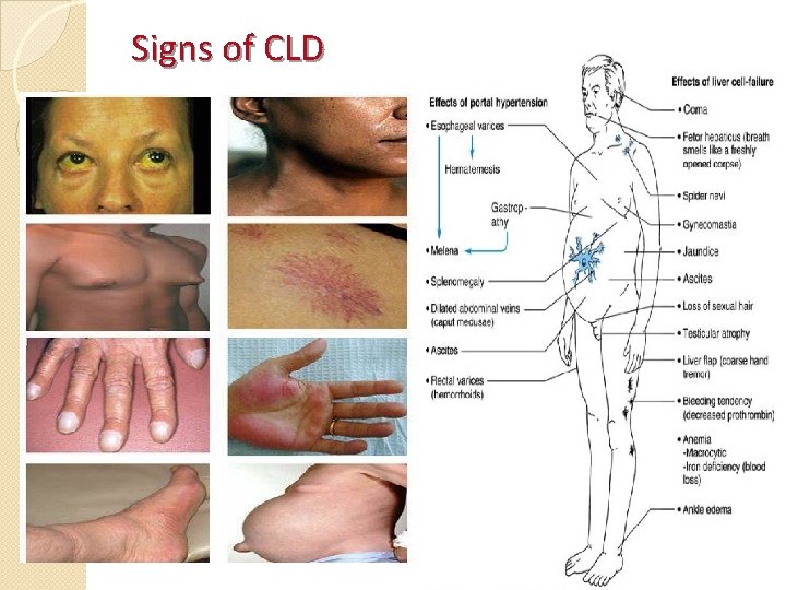 Signs of CLD 