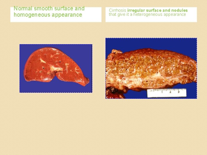 Normal smooth surface and homogeneous appearance Cirrhosis irregular surface and nodules that give it