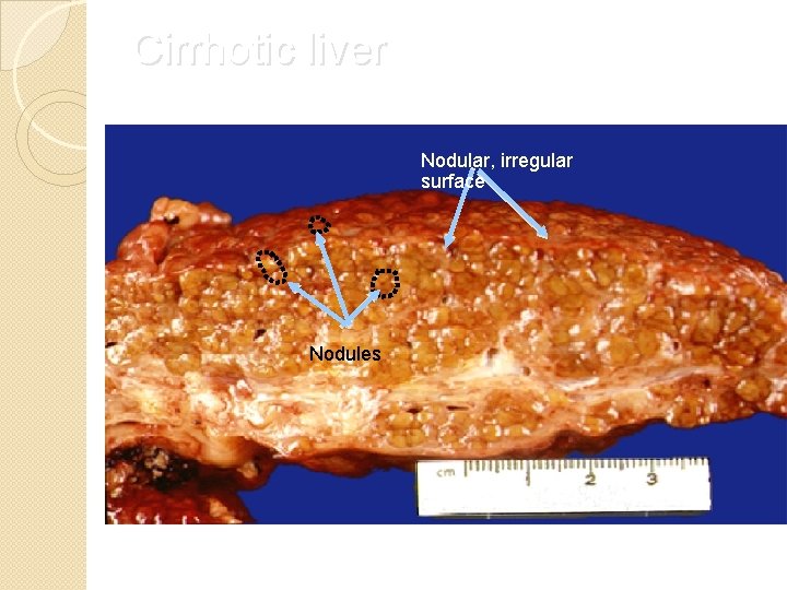Cirrhotic liver Nodular, irregular surface Nodules 
