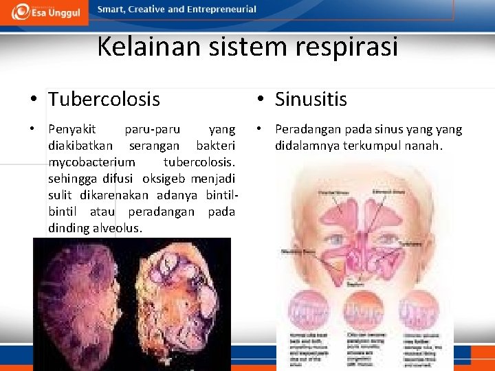 Kelainan sistem respirasi • Tubercolosis • Sinusitis • Penyakit paru-paru yang diakibatkan serangan bakteri