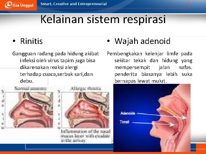 Kelainan sistem respirasi • Rinitis • Wajah adenoid Gangguan radang pada hidung akibat infeksi
