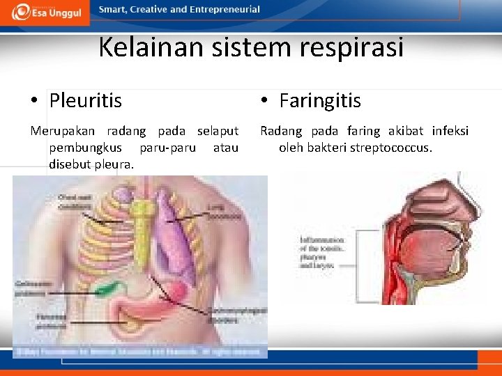 Kelainan sistem respirasi • Pleuritis • Faringitis Merupakan radang pada selaput pembungkus paru-paru atau