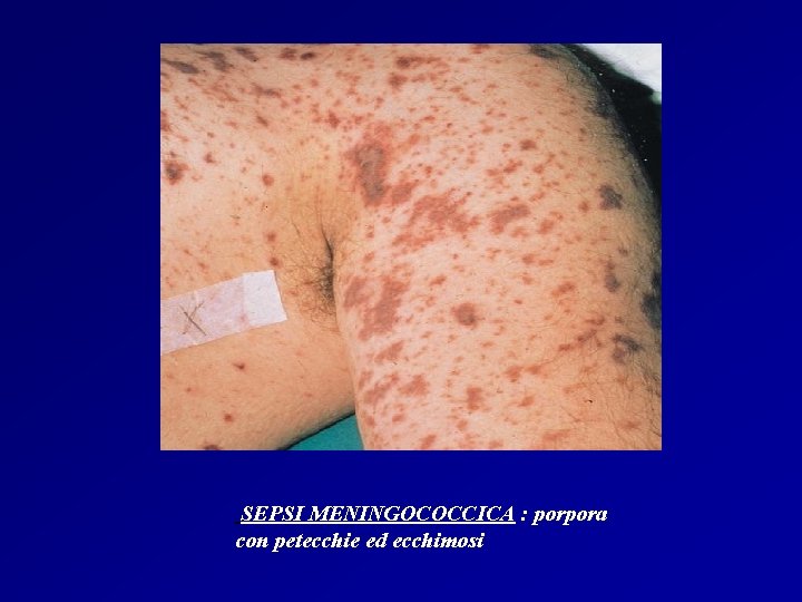 SEPSI MENINGOCOCCICA : porpora con petecchie ed ecchimosi SEPSI MENINGOCOCCICA : porpora con petecchie ed ecchimosi