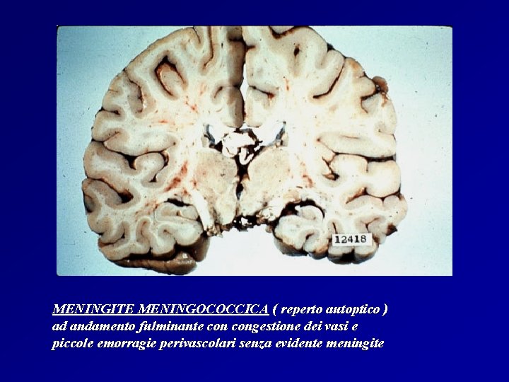 MENINGITE MENINGOCOCCICA ( reperto autoptico ) ad andamento fulminante congestione dei vasi e piccole
