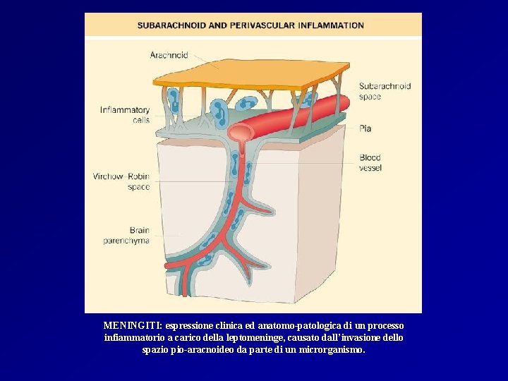 MENINGITI: espressione clinica ed anatomo-patologica di un processo infiammatorio a carico della leptomeninge, causato MENINGITI: espressione clinica ed anatomo-patologica di un processo infiammatorio a carico della leptomeninge, causato
