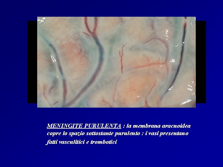 MENINGITE PURULENTA : la membrana aracnoidea copre lo spazio sottostante purulento : i vasi MENINGITE PURULENTA : la membrana aracnoidea copre lo spazio sottostante purulento : i vasi