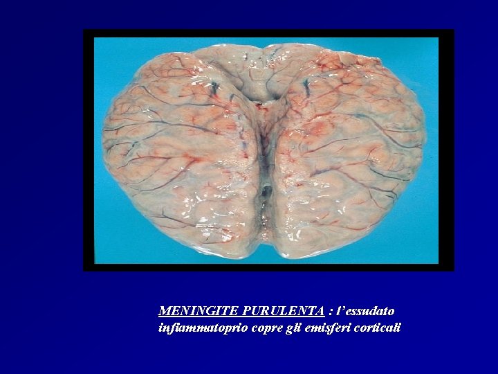 MENINGITE PURULENTA : l’essudato infiammatoprio copre gli emisferi corticali MENINGITE PURULENTA : l’essudato infiammatoprio copre gli emisferi corticali