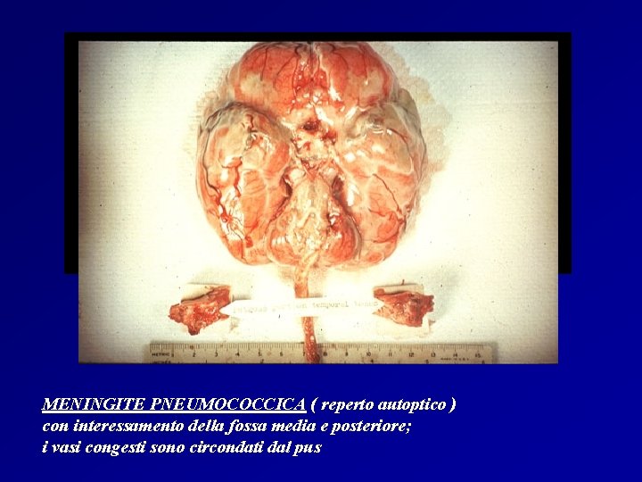 MENINGITE PNEUMOCOCCICA ( reperto autoptico ) con interessamento della fossa media e posteriore; i