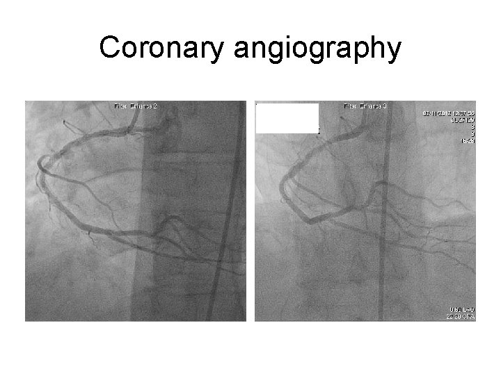 Coronary angiography 