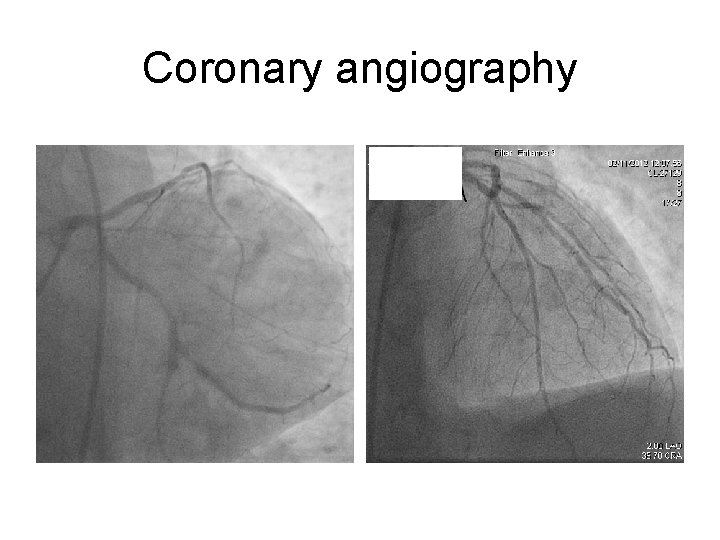 Coronary angiography 