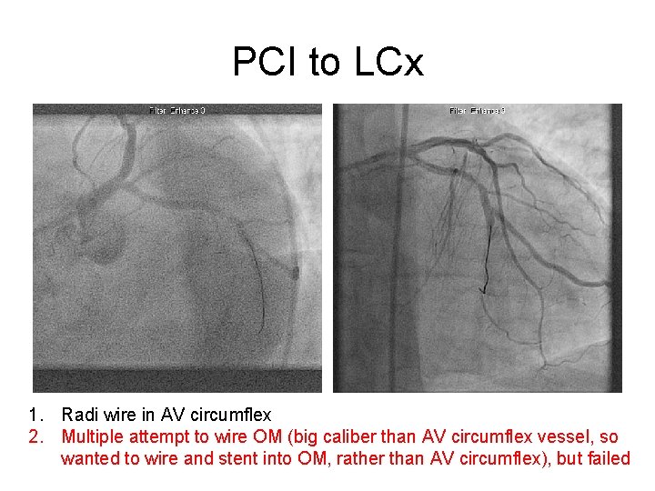 PCI to LCx 1. Radi wire in AV circumflex 2. Multiple attempt to wire