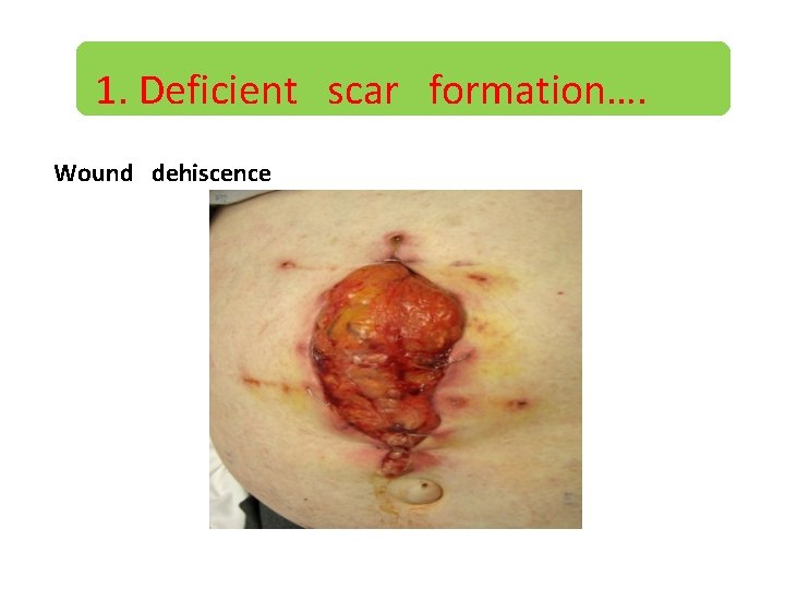 1. Deficient scar formation…. Wound dehiscence 