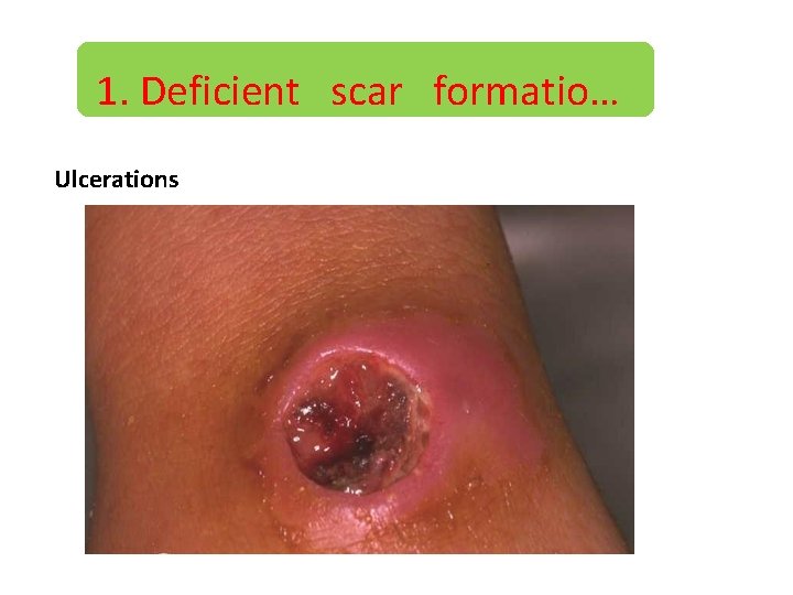 1. Deficient scar formatio… Ulcerations 