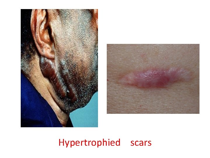 Hypertrophied scars 