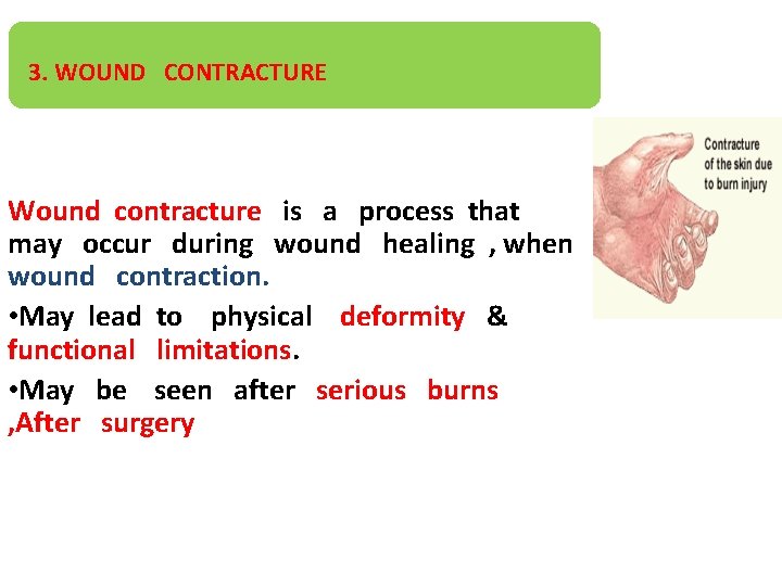 3. WOUND CONTRACTURE Wound contracture is a process that may occur during wound healing