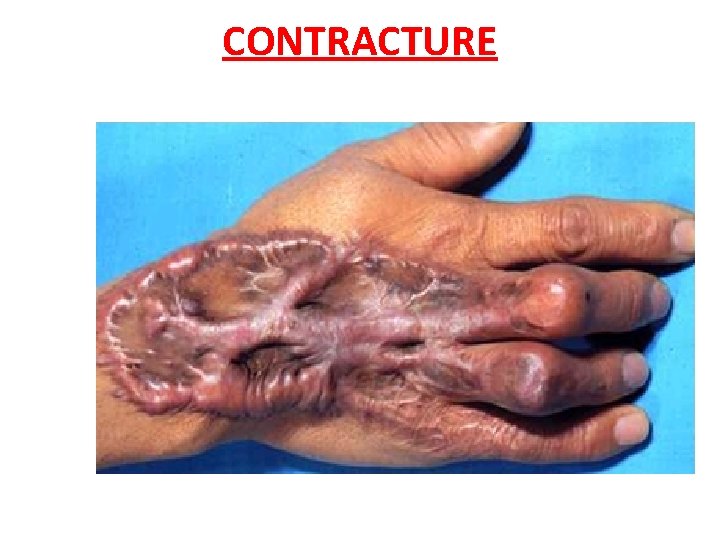 CONTRACTURE 