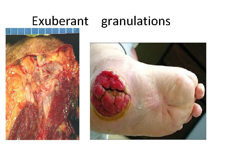 Exuberant granulations 