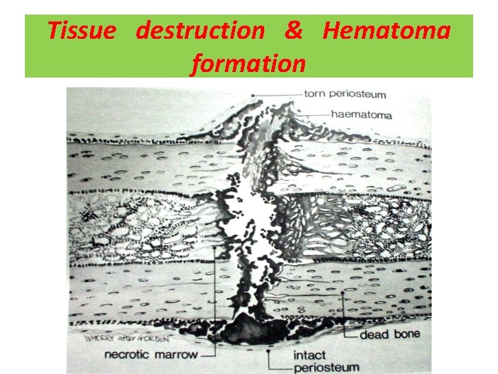 Tissue destruction & Hematoma formation 