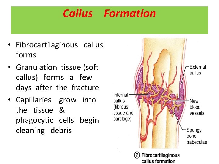 Callus Formation • Fibrocartilaginous callus forms • Granulation tissue (soft callus) forms a few