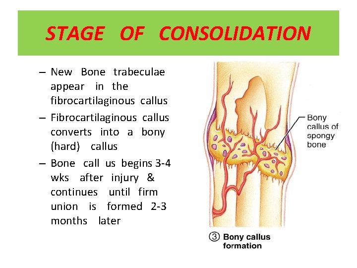 STAGE OF CONSOLIDATION – New Bone trabeculae appear in the fibrocartilaginous callus – Fibrocartilaginous
