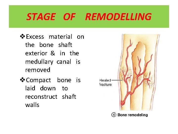 STAGE OF REMODELLING v. Excess material on the bone shaft exterior & in the