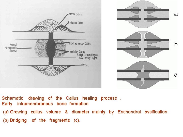 Schematic drawing of the Callus healing process. Early intramembranous bone formation (a) Growing callus