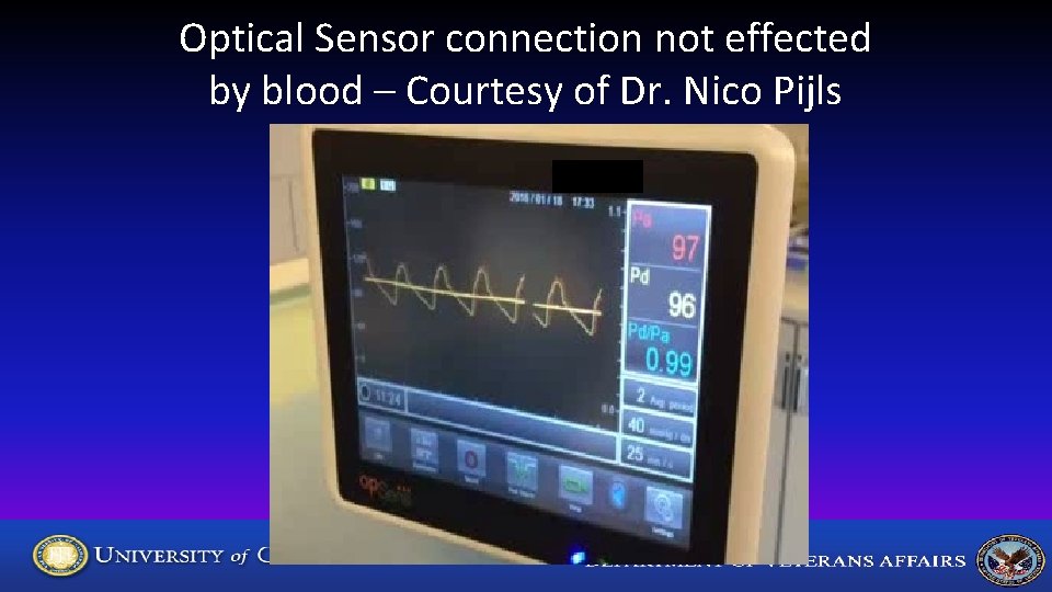 Optical Sensor connection not effected by blood – Courtesy of Dr. Nico Pijls 