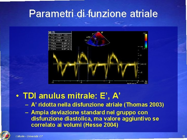 Parametri di funzione atriale • TDI anulus mitrale: E’, A’ – A’ ridotta nella