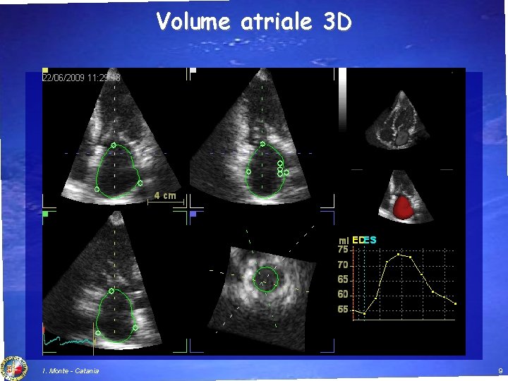 Volume atriale 3 D I. Monte - Catania 9 