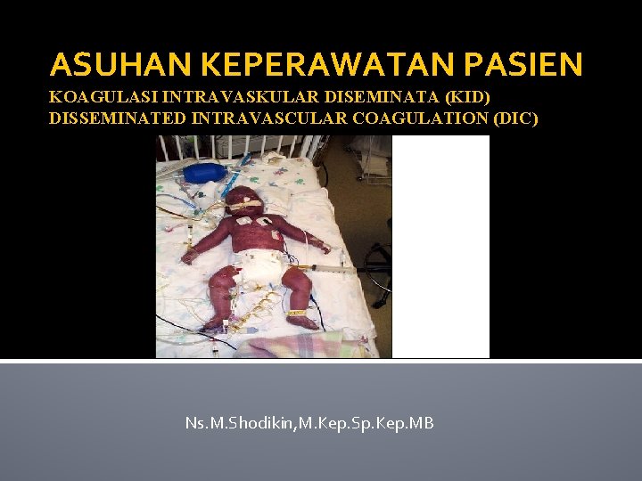 ASUHAN KEPERAWATAN PASIEN KOAGULASI INTRAVASKULAR DISEMINATA (KID) DISSEMINATED INTRAVASCULAR COAGULATION (DIC) Ns. M. Shodikin,